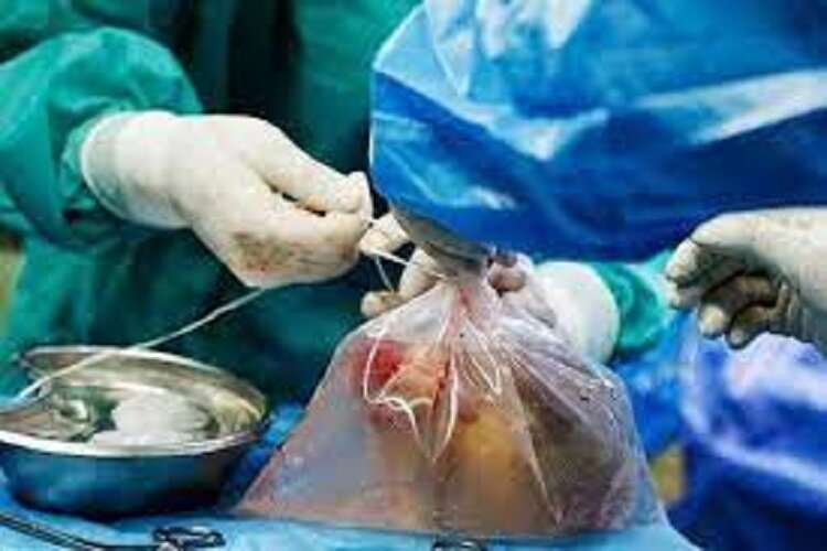 اهدای اعضای بیمار مرگ مغزی در خراسان شمالی